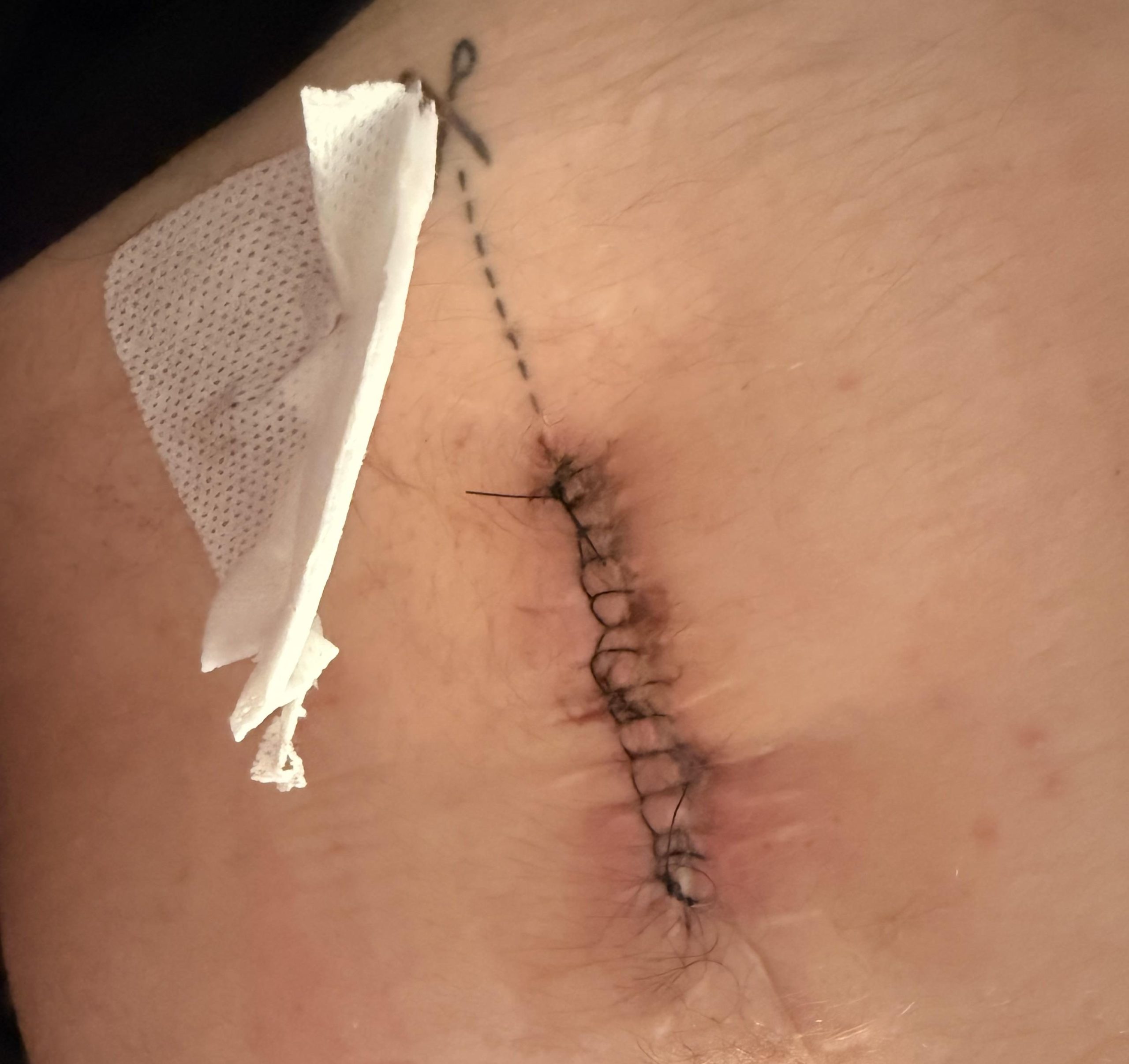 surgical wound, stitches still in, dressing cut off corner as stuck over a stitch