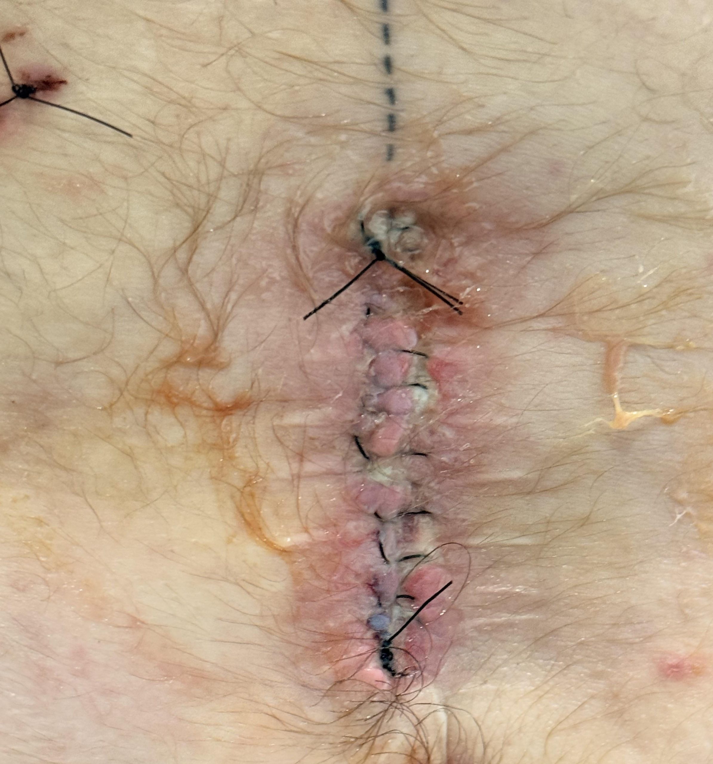 Infected wound, yellowish pus, stitches still in