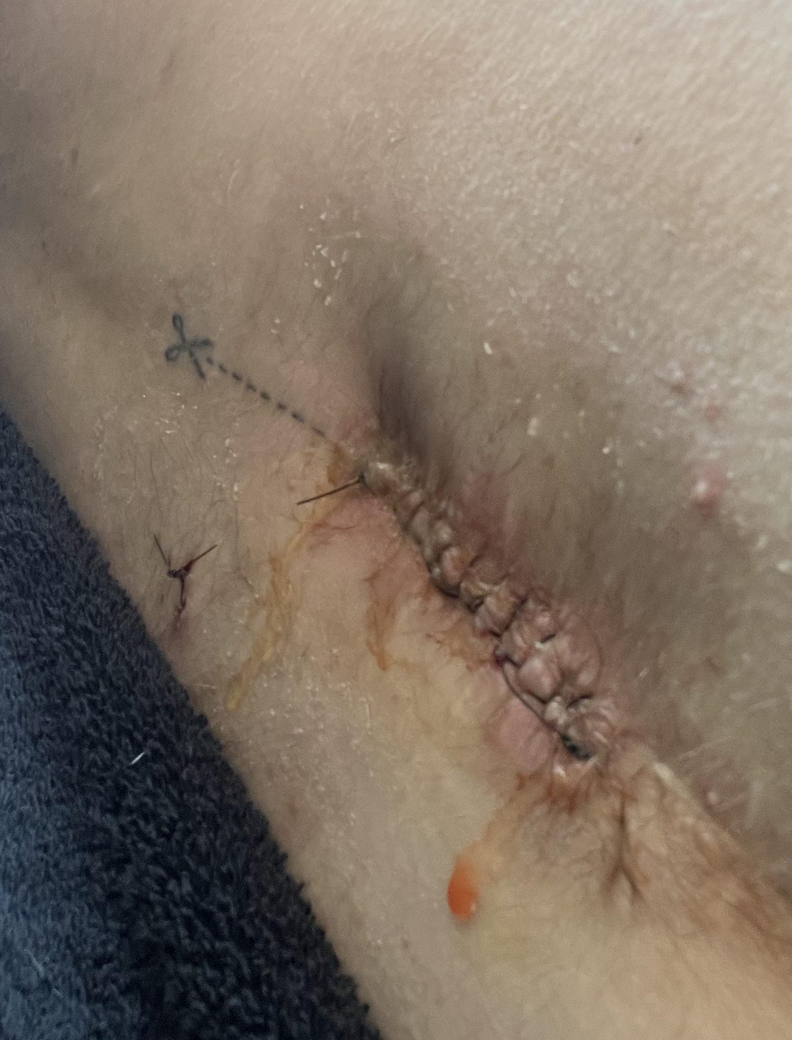 wound on back with stitches still in, scissors tattoo above. wound leaking orange fluid